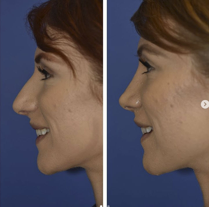 rhinoplasty tip of nose